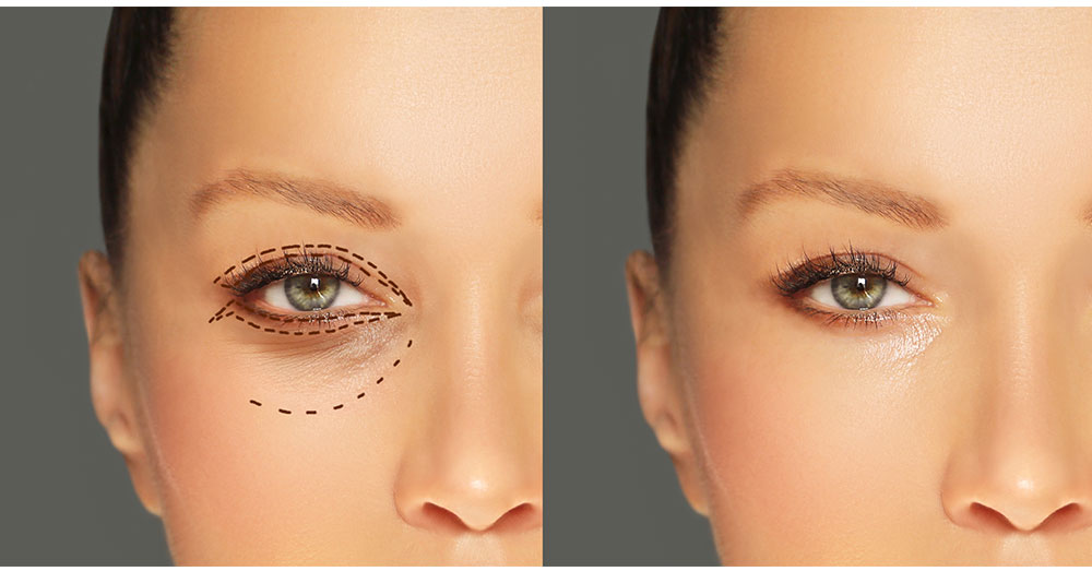Eyelid Surgery 